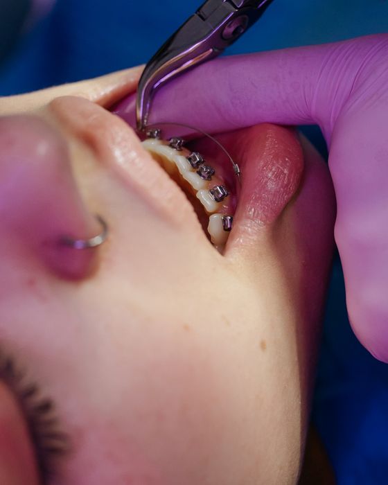 Revisión de brackets de ortodoncia